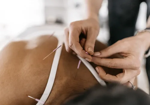 Acupuncture