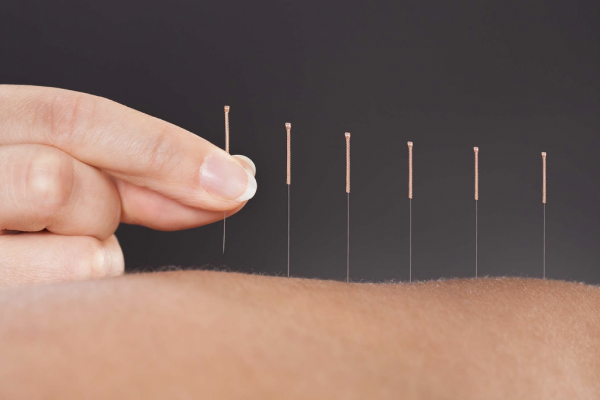 Tampa Acupuncture at Driven Fit