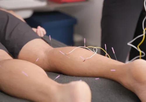 Electro-Acupuncture