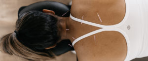 Acupuncture Tampa Driven Sponaugle Wellness