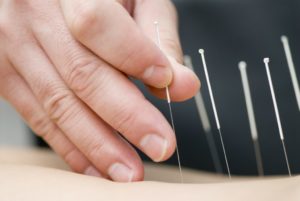 Acupuncture Allergy Relief Driven SWS Tampa FL