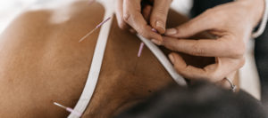 Tampa acupuncturist science behind acupuncture