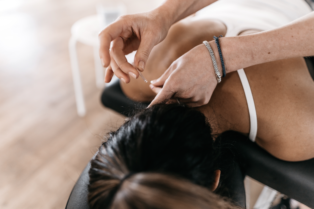 Woman getting Acupuncture to help with weight loss DrivenFit