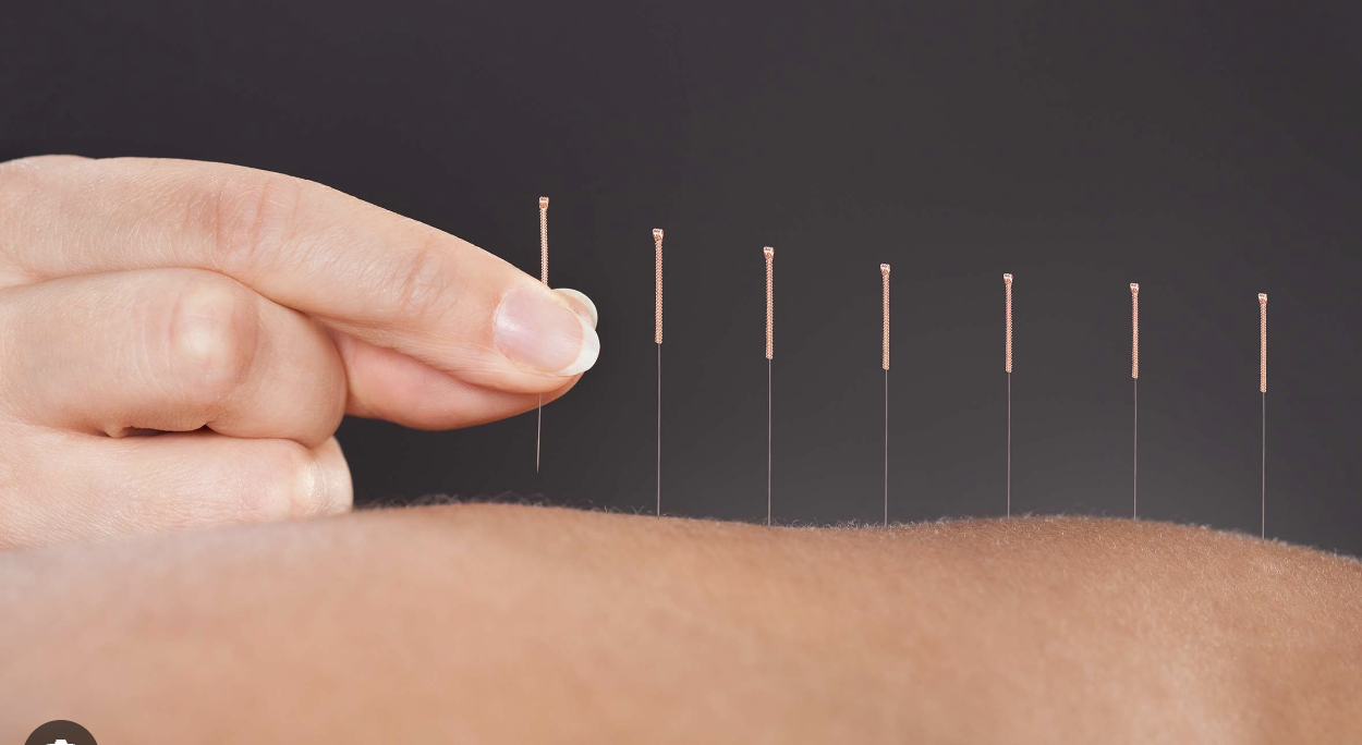 Tampa Acupuncture at Driven Fit