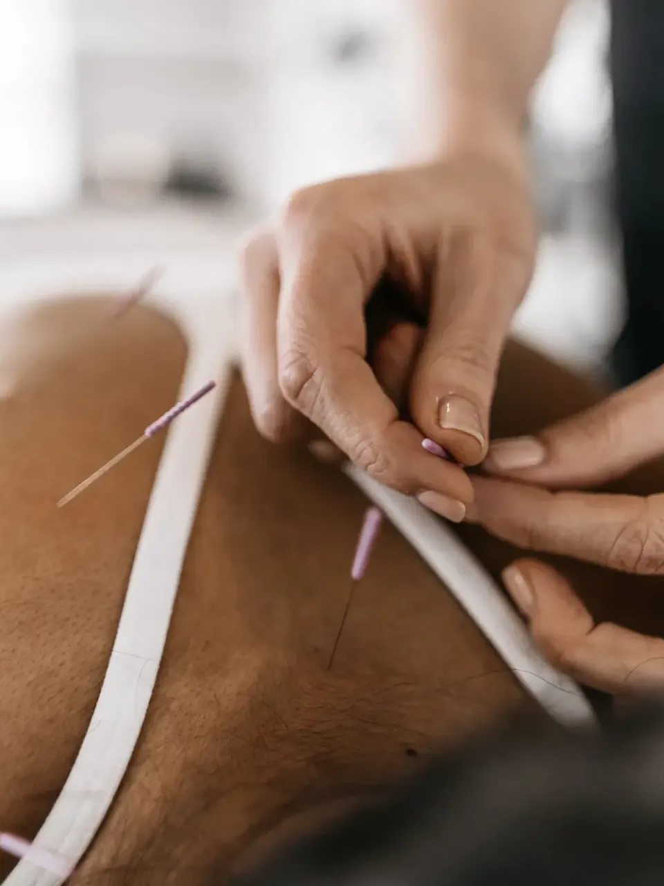 Acupuncture