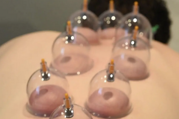 Tampa Cupping